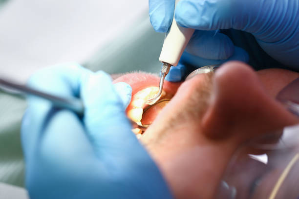 Best Emergency Broken Tooth Repair in South Sarasota, FL